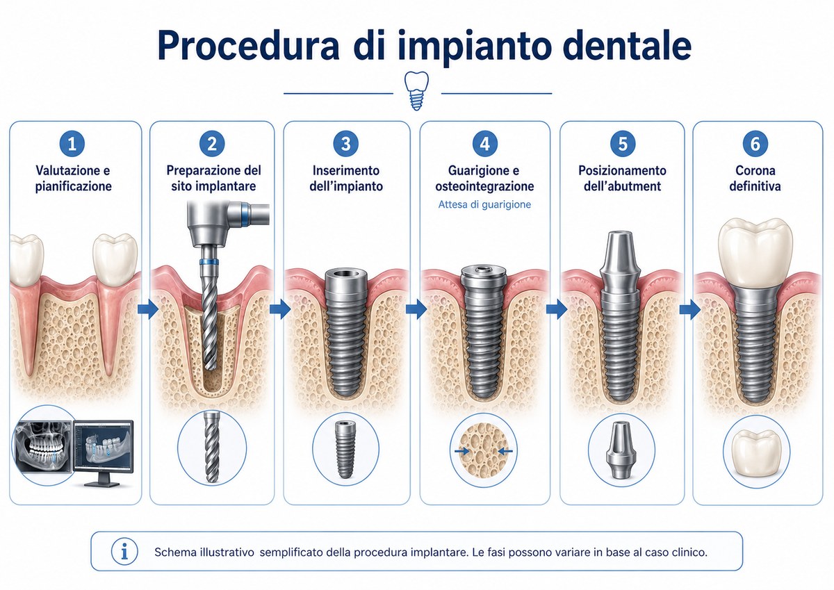 Procedura di impianto dentale in 6 passaggi: valutazione e pianificazione, preparazione del sito, inserimento dell'impianto, guarigione e osteointegrazione, posizionamento dell'abutment, corona definitiva